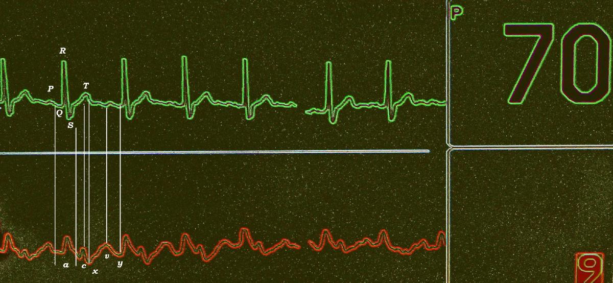 Toward robust automated cardiovascular arrhythmia detection using self-supervised learning and 1-dimensional vision transformers