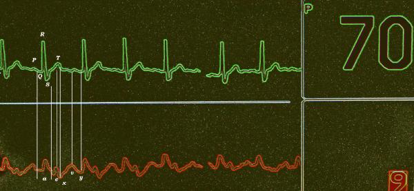 Toward robust automated cardiovascular arrhythmia detection using self-supervised learning and 1-dimensional vision transformers